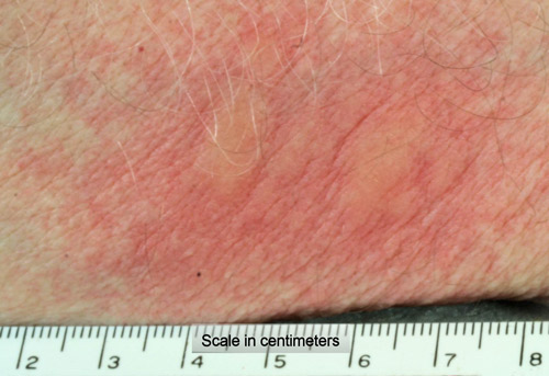 Ronchas pruriginosas y eritema resultantes del roce de los pelos de las coletas dorsales de la polilla del abeto (Orgyia detrita) en el antebrazo del autor.