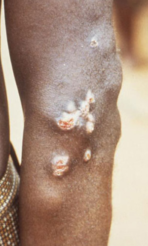This person has yaws with 8 month-old juxta-articular nodules on the left elbow. 
