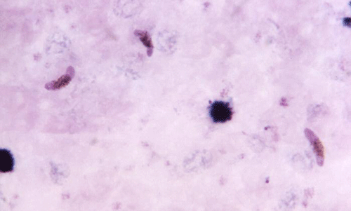 Three pink crescent shaped Plasmodium falciparum gametocytes, which are the cells that divide to form reproductive cells. 