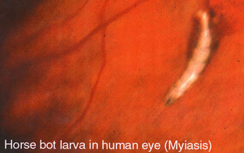 First stage larva of a horse bot fly, Gasterophilus sp., in a human eye. 