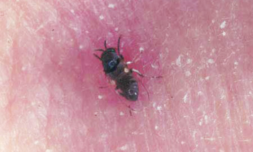 Black fly, Simulium sp., feeding on man.