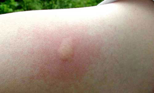 Symptoms of an individual sting by the European fire ant, Myrmica rubra Linnaeus.
