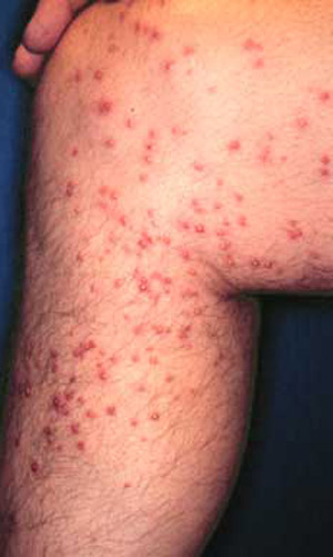White pustules formed after attack by the red imported fire ant, Solenopsis invicta Buren. 
