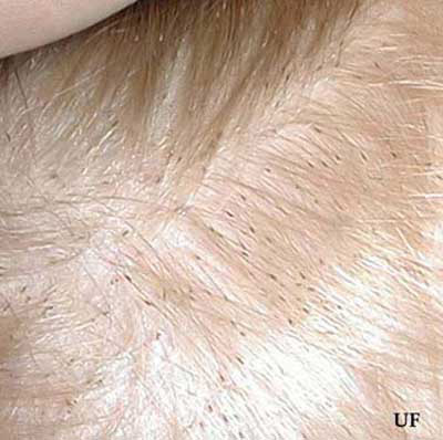 Nits (eggs) of head lice, Pediculus humanus capitis De Geer, on scalp. 